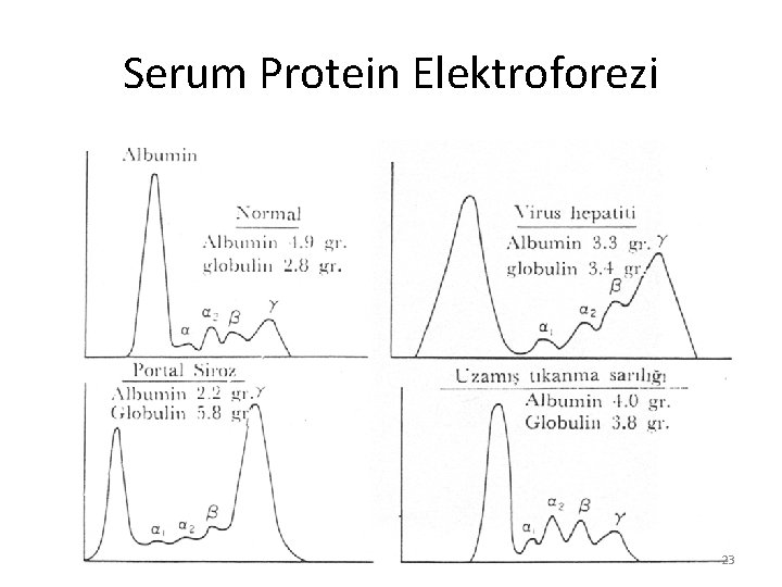 Serum Protein Elektroforezi 23 