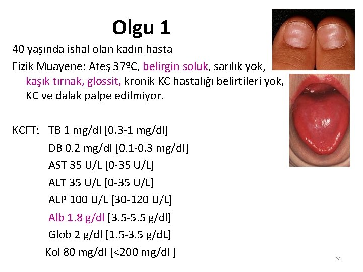 Olgu 1 40 yaşında ishal olan kadın hasta Fizik Muayene: Ateş 37ºC, belirgin soluk,