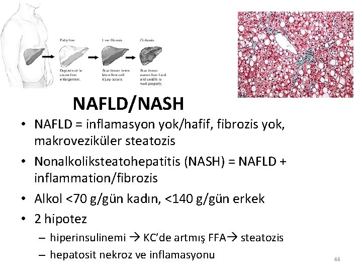 NAFLD/NASH • NAFLD = inflamasyon yok/hafif, fibrozis yok, makroveziküler steatozis • Nonalkoliksteatohepatitis (NASH) =