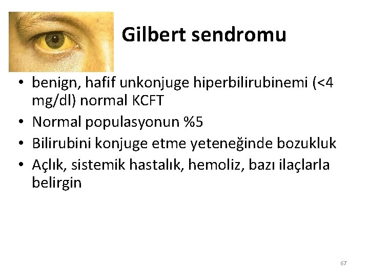 Gilbert sendromu • benign, hafif unkonjuge hiperbilirubinemi (<4 mg/dl) normal KCFT • Normal populasyonun