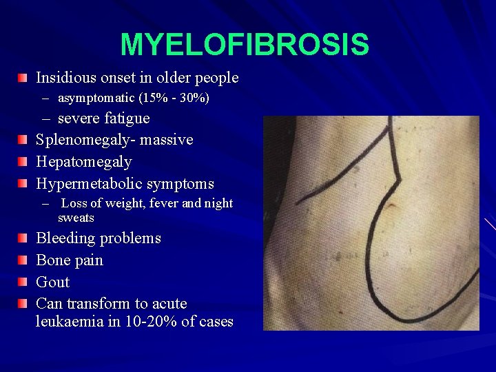 MYELOFIBROSIS Insidious onset in older people – asymptomatic (15% - 30%) – severe fatigue
