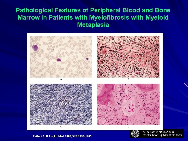 Pathological Features of Peripheral Blood and Bone Marrow in Patients with Myelofibrosis with Myeloid