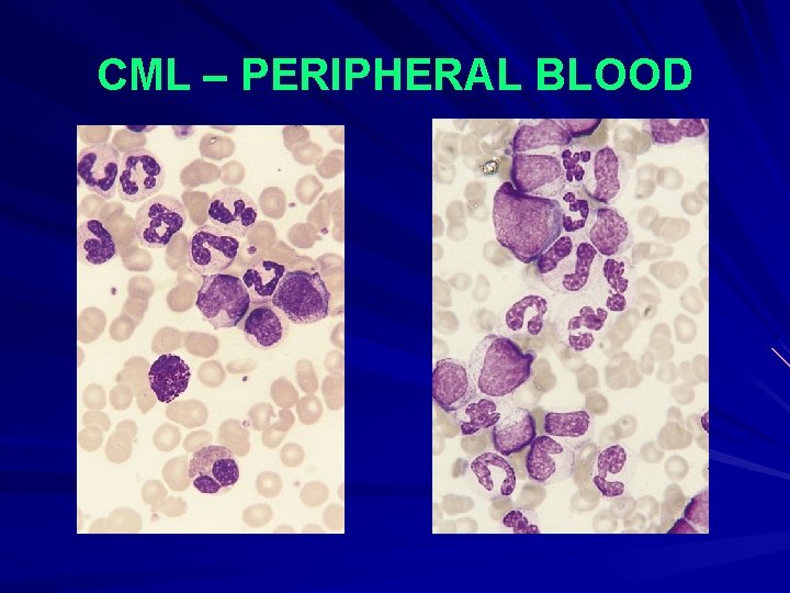 CML – PERIPHERAL BLOOD 