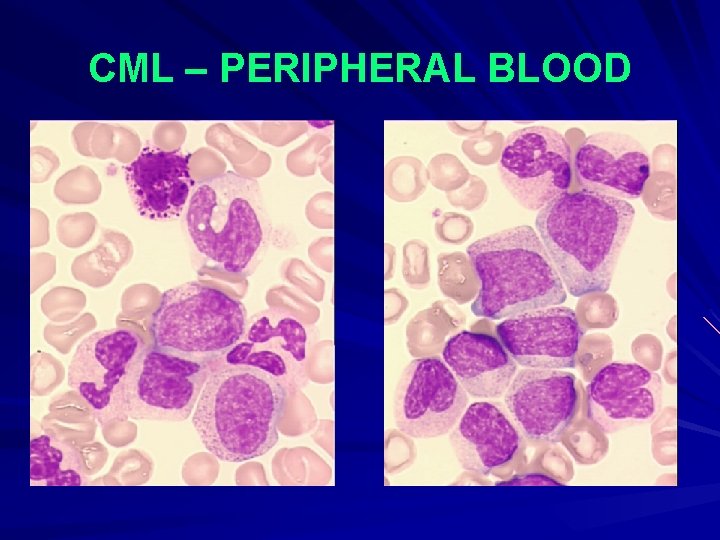 CML – PERIPHERAL BLOOD 