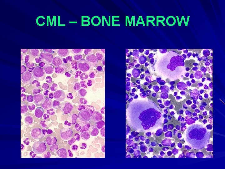 CML – BONE MARROW 