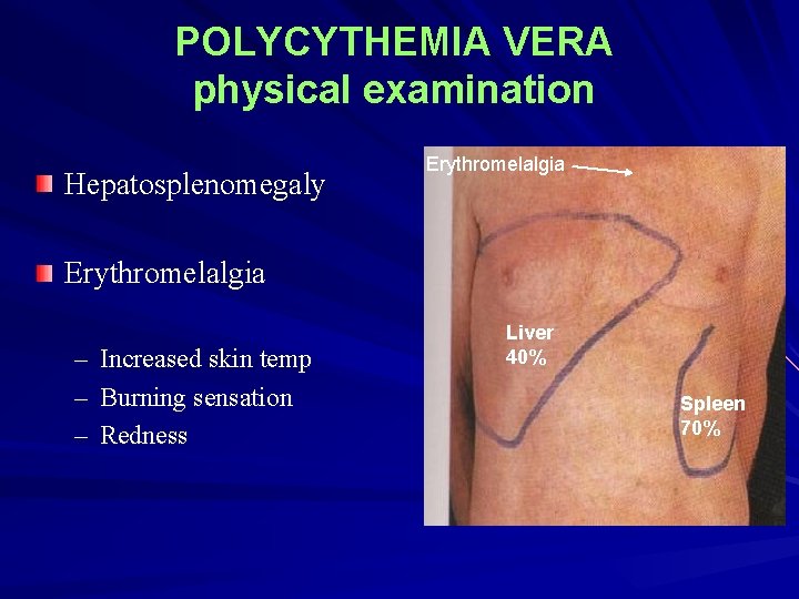 POLYCYTHEMIA VERA physical examination Hepatosplenomegaly Erythromelalgia – – – Increased skin temp Burning sensation