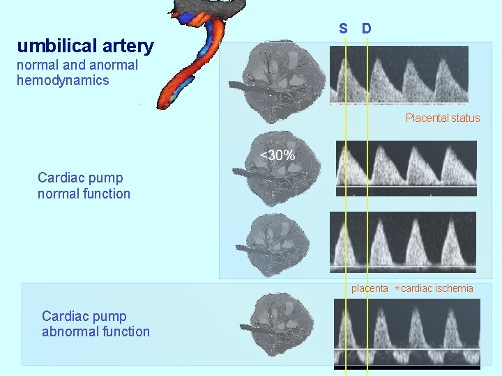 S umbilical artery D normal and anormal hemodynamics Placental status <30% Cardiac pump normal