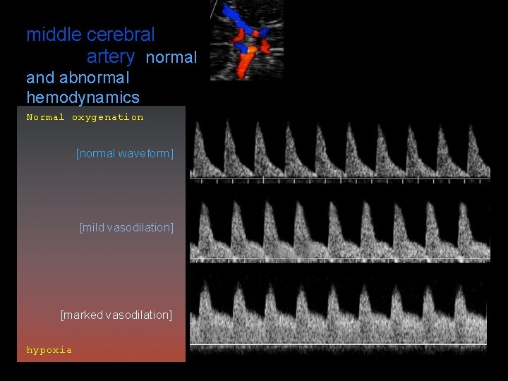 middle cerebral artery normal and abnormal hemodynamics Normal oxygenation [normal waveform] [mild vasodilation] [marked