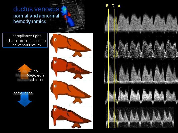 ductus venosus normal and abnormal hemodynamics compliance right chambers: effect sobre on venous return