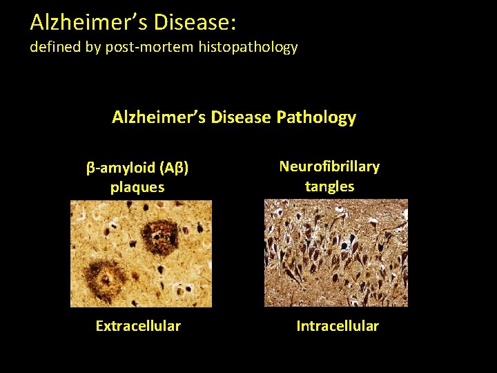 Alzheimer’s Disease: defined by post-mortem histopathology Alzheimer’s Disease Pathology β-amyloid (Aβ) plaques Extracellular Neurofibrillary