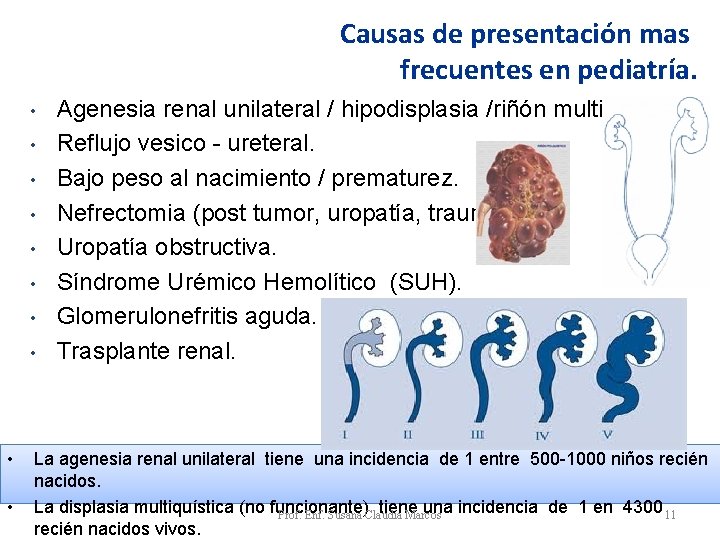 Causas de presentación mas frecuentes en pediatría. • • • Agenesia renal unilateral / Causas de presentación mas frecuentes en pediatría. • • • Agenesia renal unilateral /