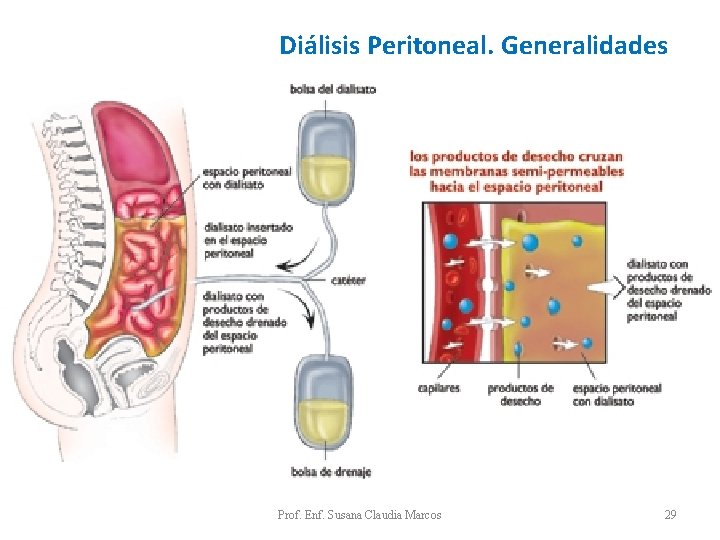 Diálisis Peritoneal. Generalidades Prof. Enf. Susana Claudia Marcos 29 Diálisis Peritoneal. Generalidades Prof. Enf. Susana Claudia Marcos 29