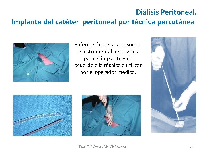 Diálisis Peritoneal. Implante del catéter peritoneal por técnica percutánea Enfermería prepara insumos e instrumental Diálisis Peritoneal. Implante del catéter peritoneal por técnica percutánea Enfermería prepara insumos e instrumental