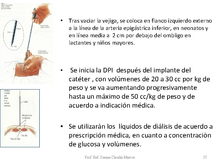 • Tras vaciar la vejiga, se coloca en flanco izquierdo externo a la • Tras vaciar la vejiga, se coloca en flanco izquierdo externo a la