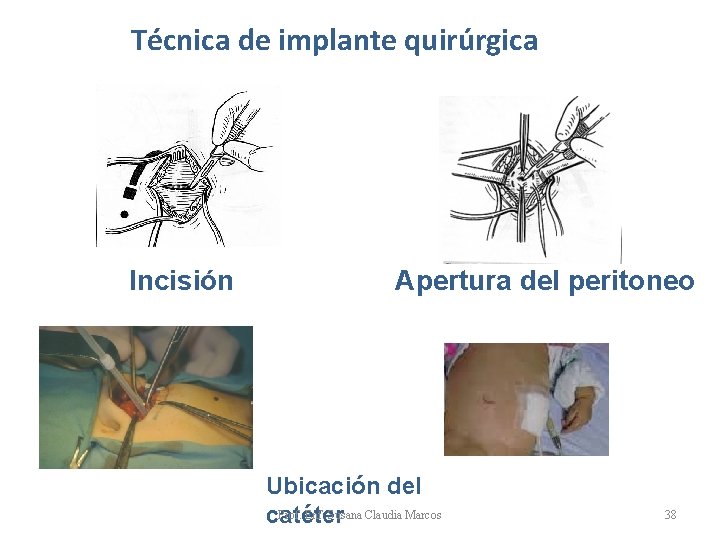 Técnica de implante quirúrgica Incisión Apertura del peritoneo Ubicación del Prof. Enf. Susana Claudia Técnica de implante quirúrgica Incisión Apertura del peritoneo Ubicación del Prof. Enf. Susana Claudia