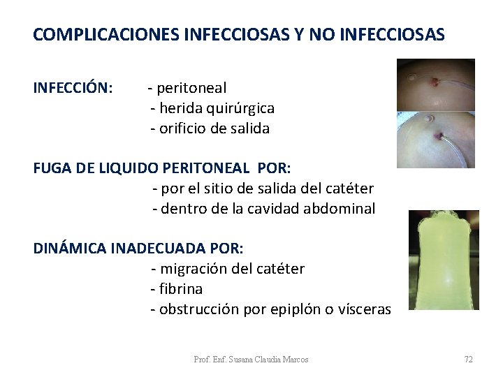 COMPLICACIONES INFECCIOSAS Y NO INFECCIOSAS INFECCIÓN: - peritoneal - herida quirúrgica - orificio de COMPLICACIONES INFECCIOSAS Y NO INFECCIOSAS INFECCIÓN: - peritoneal - herida quirúrgica - orificio de