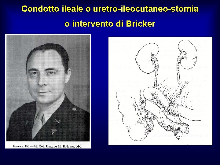 Condotto ileale o uretro-ileocutaneo-stomia o intervento di Bricker 