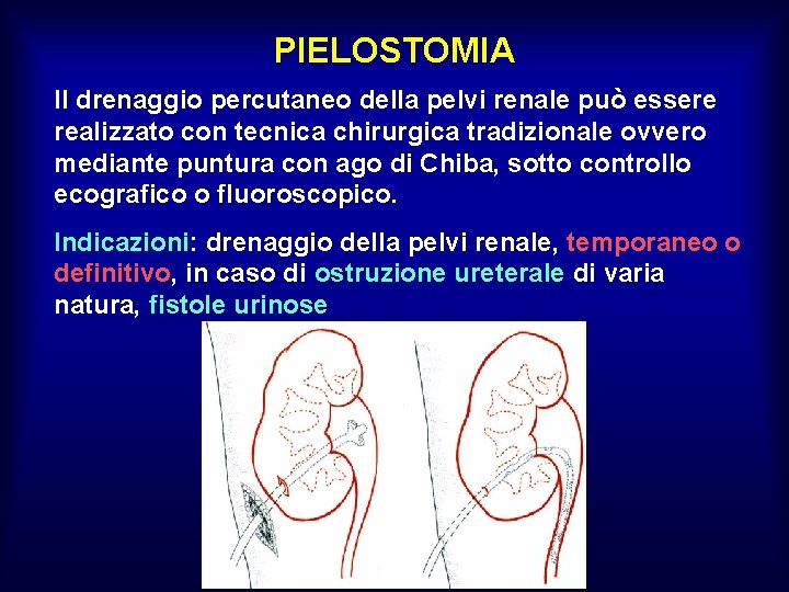 PIELOSTOMIA Il drenaggio percutaneo della pelvi renale può essere realizzato con tecnica chirurgica tradizionale