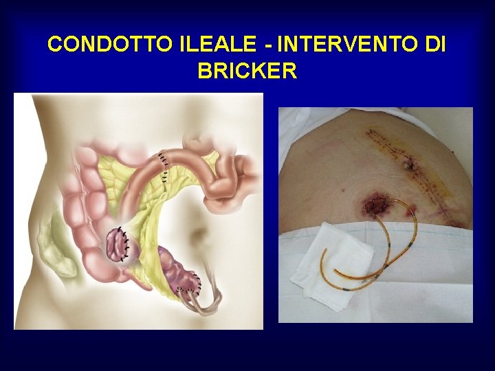 CONDOTTO ILEALE - INTERVENTO DI BRICKER 