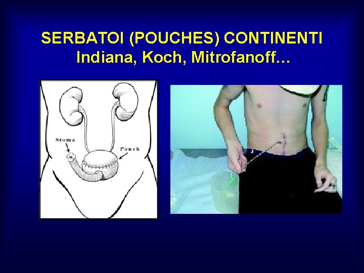 SERBATOI (POUCHES) CONTINENTI Indiana, Koch, Mitrofanoff… 