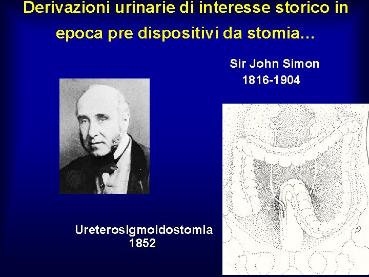 Derivazioni urinarie di interesse storico in epoca pre dispositivi da stomia… Sir John Simon