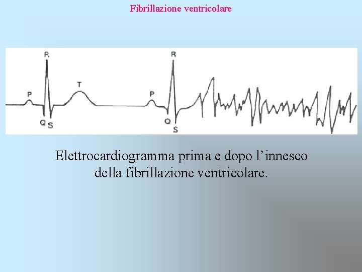 Fibrillazione ventricolare Elettrocardiogramma prima e dopo l’innesco della fibrillazione ventricolare. 