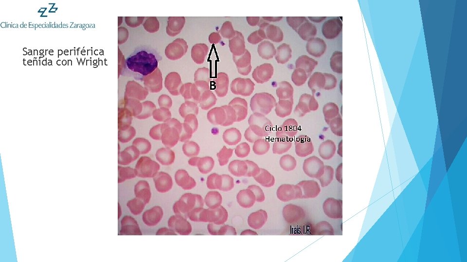 Sangre periférica teñida con Wright 