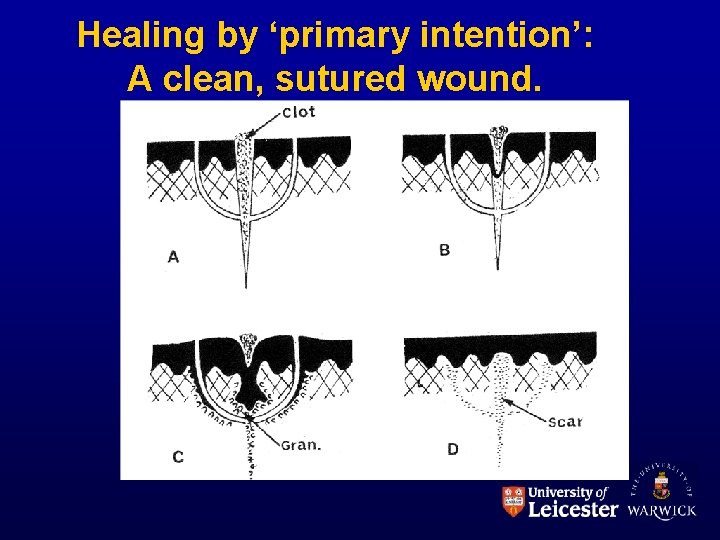 Healing by ‘primary intention’: A clean, sutured wound. 