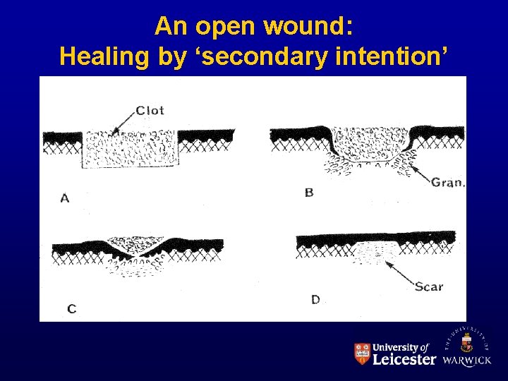 An open wound: Healing by ‘secondary intention’ 