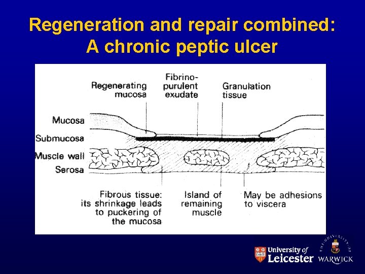 Regeneration and repair combined: A chronic peptic ulcer 
