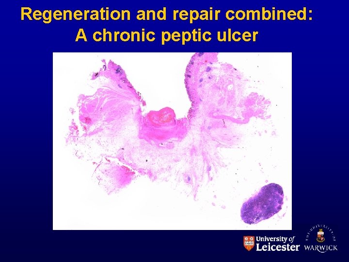 Regeneration and repair combined: A chronic peptic ulcer Regeneration and repair combined: A chronic peptic ulcer