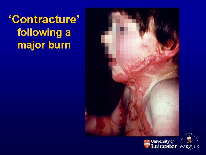 ‘Contracture’ following a major burn 