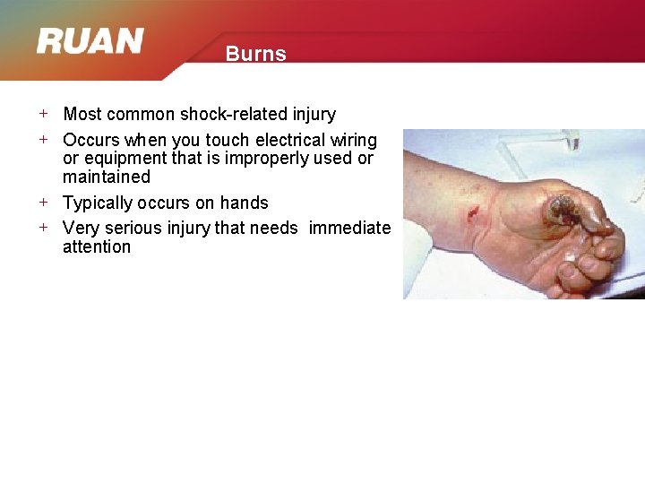 Burns + Most common shock-related injury + Occurs when you touch electrical wiring or