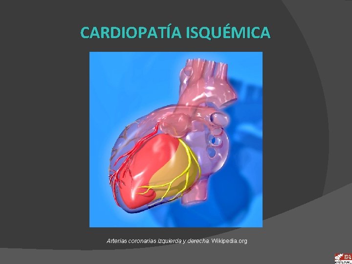 CARDIOPATÍA ISQUÉMICA Arterias coronarias izquierda y derecha. Wikipedia. org 