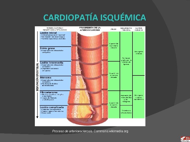 CARDIOPATÍA ISQUÉMICA Proceso de arterioesclerosis. Commons. wikimedia. org 