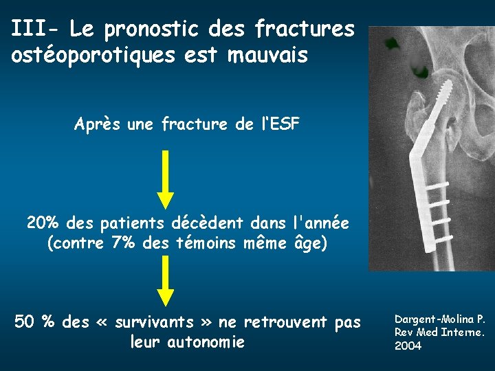 III- Le pronostic des fractures ostéoporotiques est mauvais Après une fracture de l‘ESF 20%