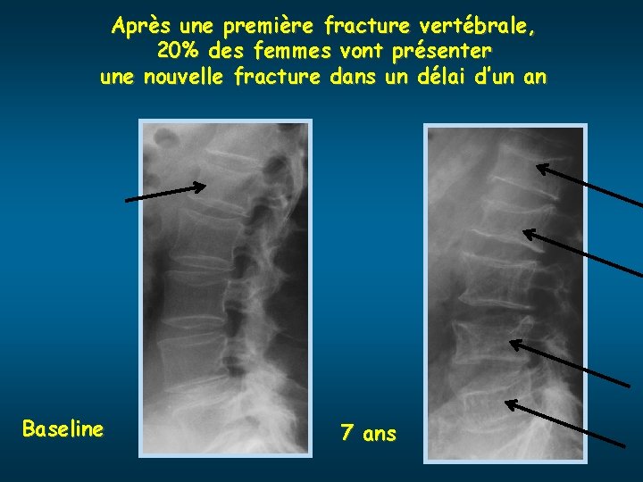 Après une première fracture vertébrale, 20% des femmes vont présenter une nouvelle fracture dans