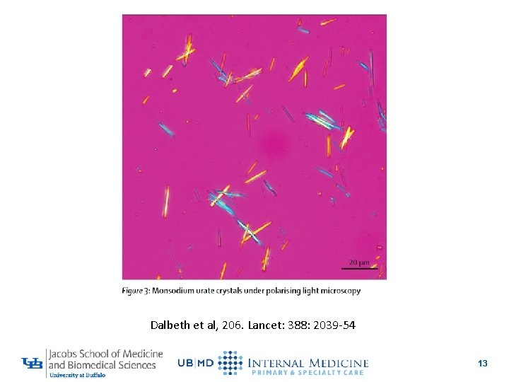 Dalbeth et al, 206. Lancet: 388: 2039 -54 13 