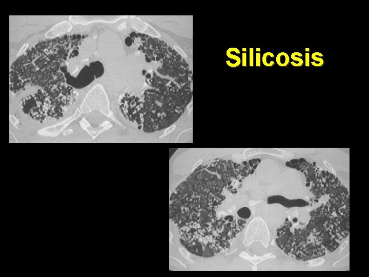 Silicosis 