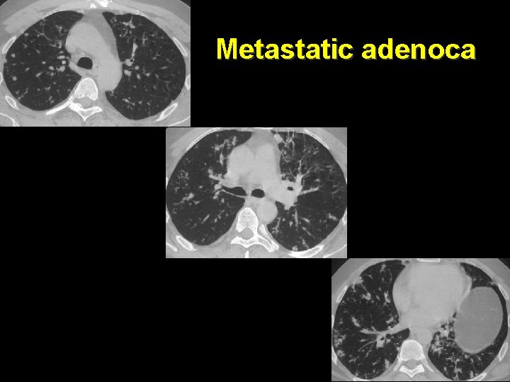 Metastatic adenoca 