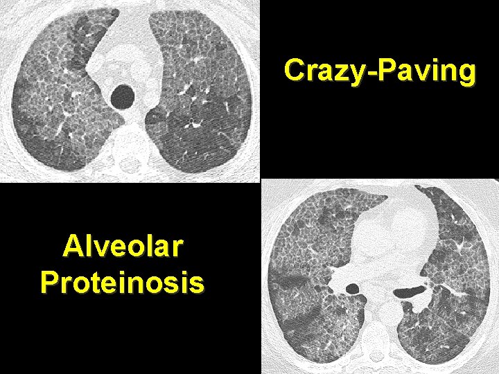 Crazy-Paving Alveolar Proteinosis 