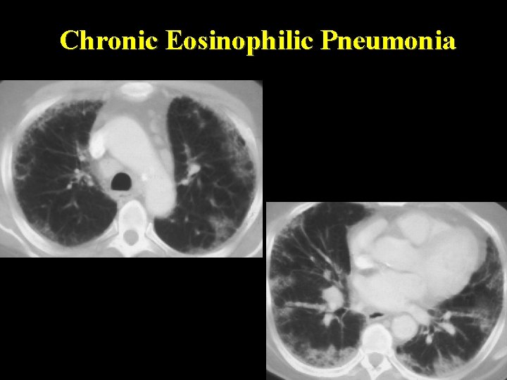 Chronic Eosinophilic Pneumonia 