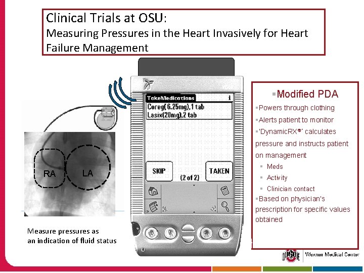 Clinical Trials at OSU: Measuring Pressures in the Heart Invasively for Heart Failure Management