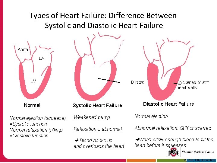 Types of Heart Failure: Difference Between Systolic and Diastolic Heart Failure Aorta LA LV