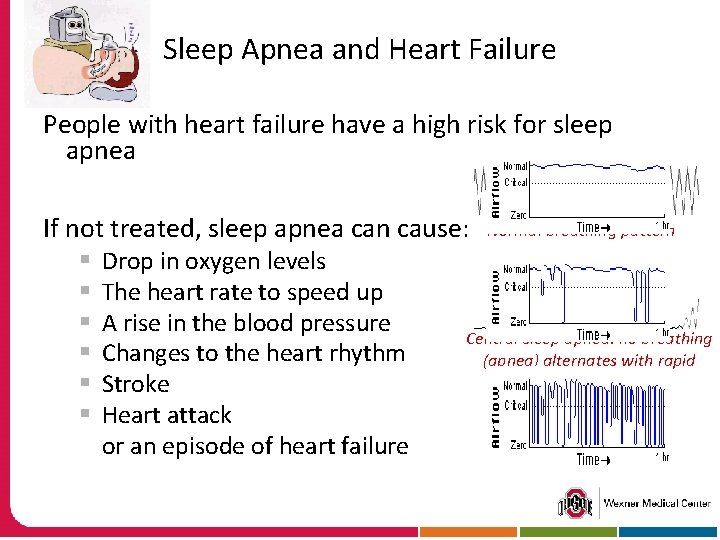 Sleep Apnea and Heart Failure People with heart failure have a high risk for