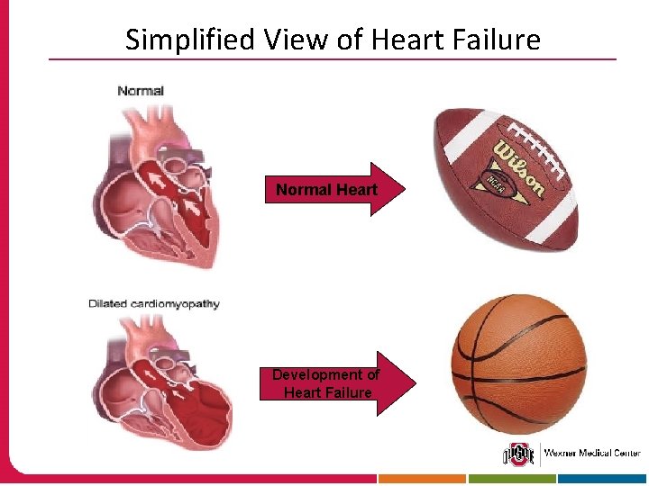 Simplified View of Heart Failure Normal Heart Development of Heart Failure 