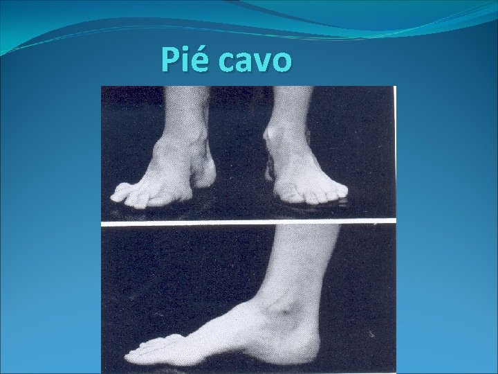 Pié cavo 