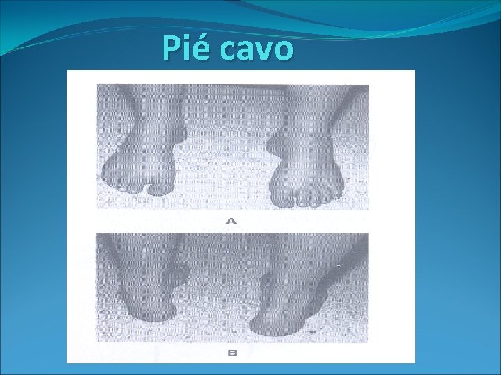 Pié cavo 