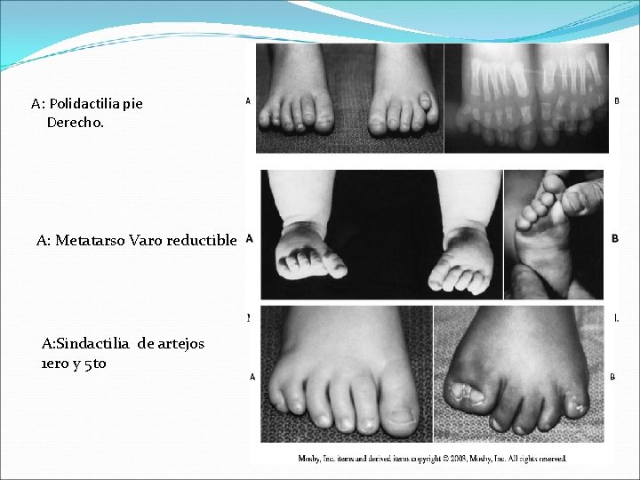 A: Polidactilia pie Derecho. A: Metatarso Varo reductible A: Sindactilia de artejos 1 ero
