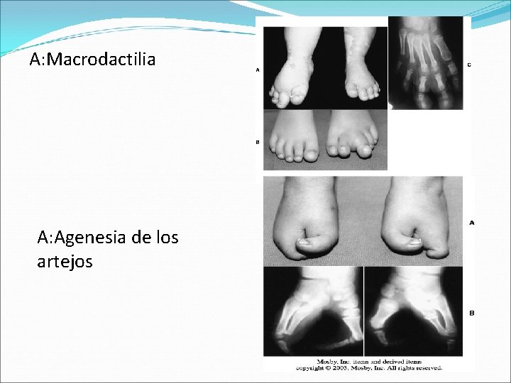 A: Macrodactilia A: Agenesia de los artejos 